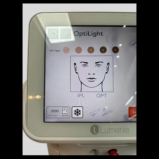 Optilight Dry Eye Lumenis