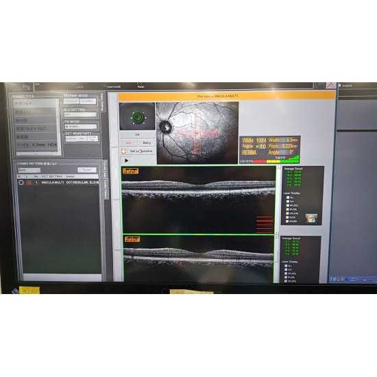 OCT Nidek RS-3000 Advance OCT Nidek RS-3000 Advance